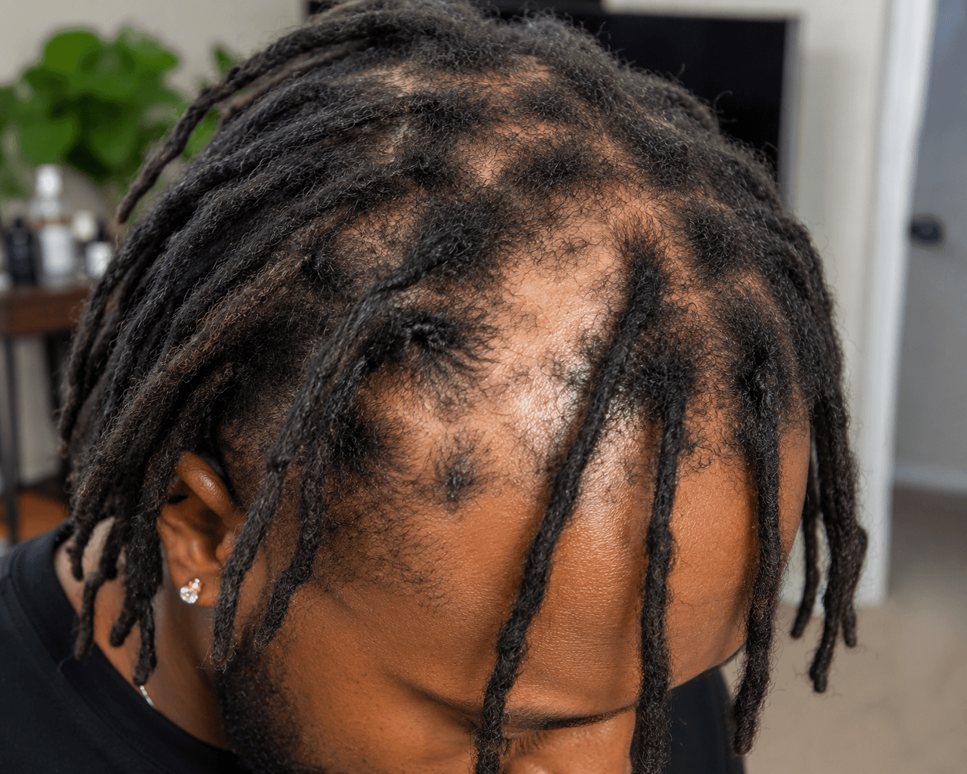Locs and traction alopecia